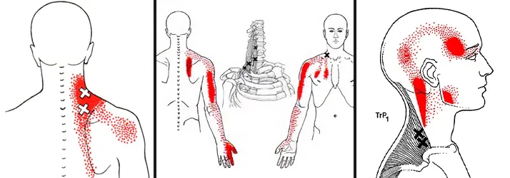 Chiropractic Glendale CA Trigger Points